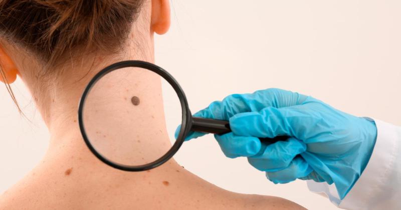 �Qué es el melanoma su prevención las recomendaciones para el cuidado de la piel y cómo realizar un auto control