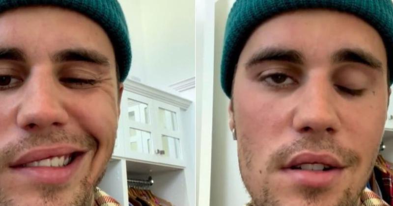 Justin Bieber canceloacute varios shows de su gira por sufrir una paraacutelisis facial